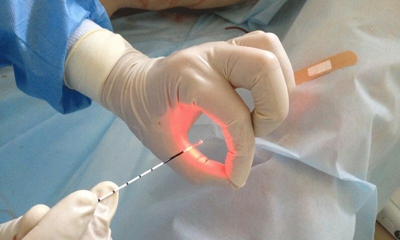 prostatit için lazer tedavisi