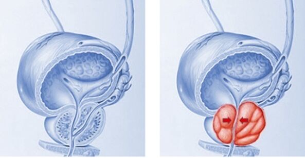 prostatit ile sağlıklı ve iltihaplı prostat