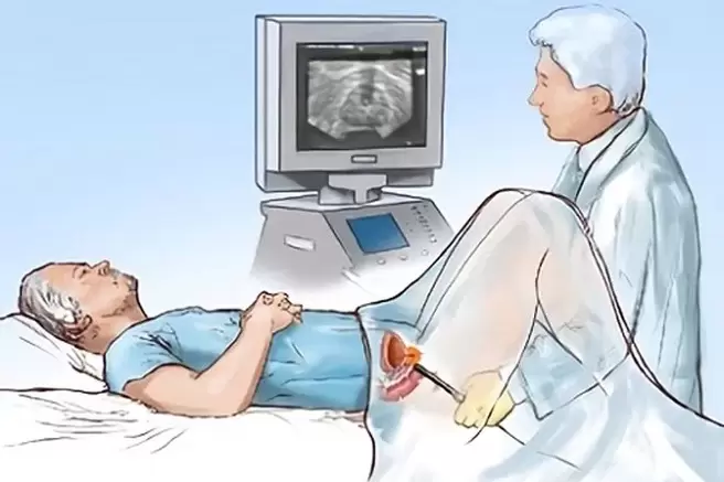 prostatit tanısı
